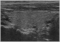 Sonographie Längsschnitt einer normalen Schilddrüse