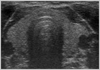 Sonographie Querschnitt einer normalen Schilddrüse
